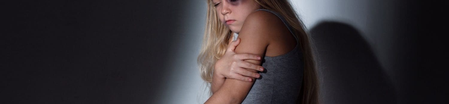 Child with bruising Child with bruising