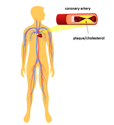 Coronary artery