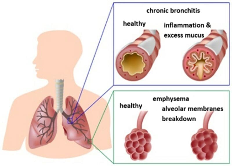 airways with COPD