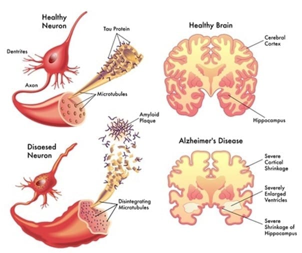 the deterioration of the brain the deterioration of the brain