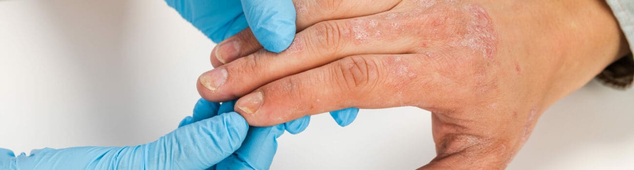 Most Common Childhood Allergies Most Common Childhood Allergies