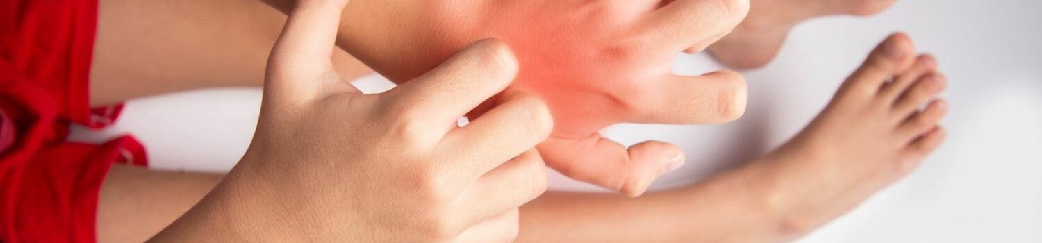 Understanding and Managing Allergies in Children Understanding and Managing Allergies in Children